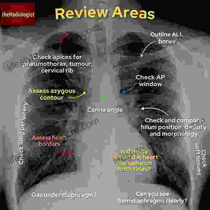 An X Ray Image Of A Chest, Showing The Heart, Lungs, And Ribs. The Unofficial Guide To Radiology: Chest Abdominal Orthopaedic X Rays Plus CTs MRIs And Other Important Modalities (Unofficial Guides To Medicine)